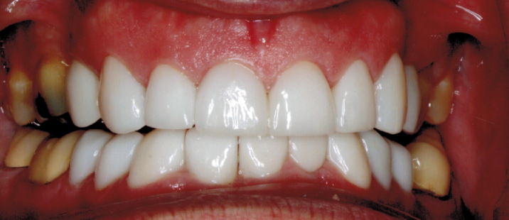 Anterior teeth after dental crown restoration - fully restored appearance and function