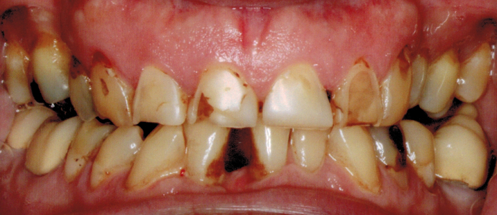 Anterior teeth before dental crown and bridge restoration in Katy, TX