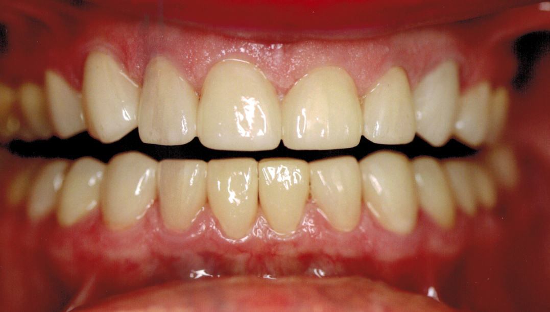 Smile after complete full mouth restoration at Bethke Family and Cosmetic Dentistry, Katy TX