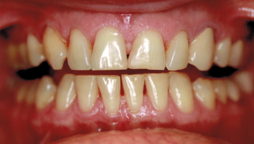 Smile before full mouth restoration treatment in Katy, TX