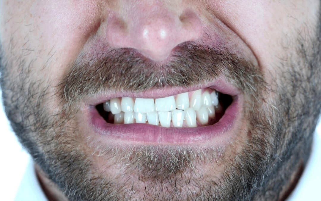 Restored teeth after bruxism treatment at Bethke Family and Cosmetic Dentistry