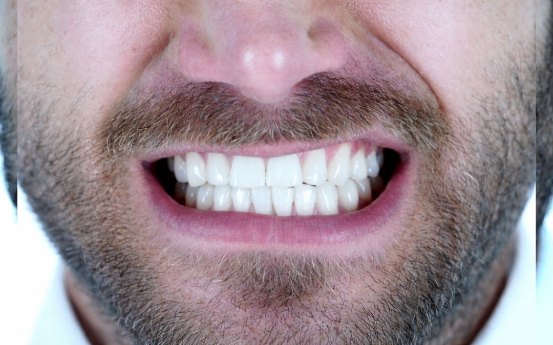 Worn teeth from grinding before bruxism nightguard treatment in Katy, TX