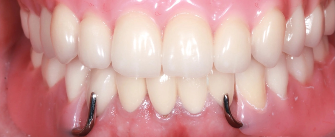 Patient with new custom dentures - natural-looking, comfortable smile