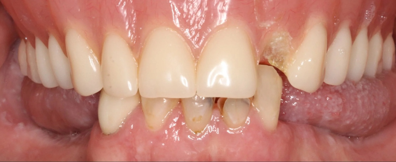 Patient smile before custom denture fitting in Katy, TX