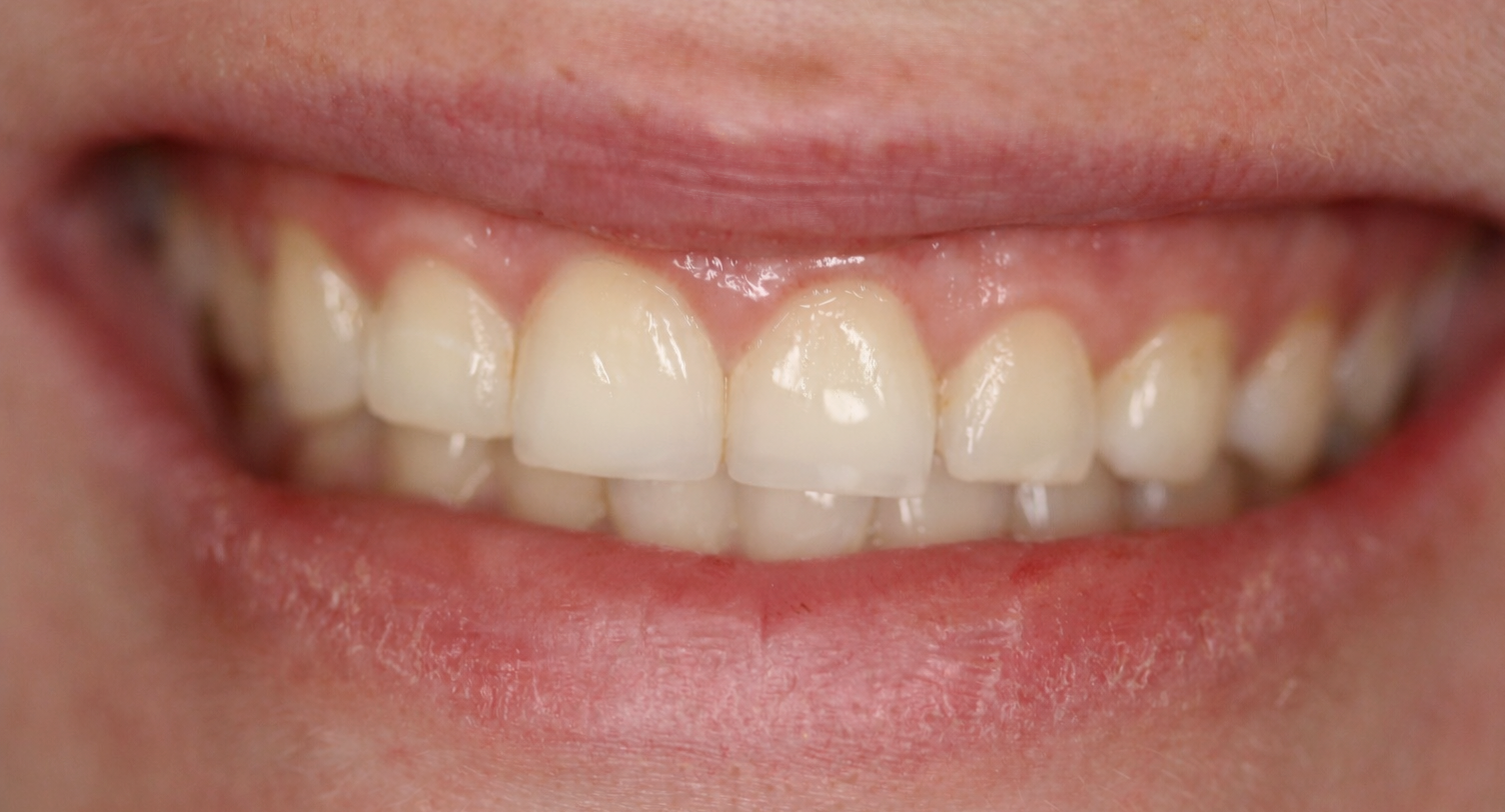 Tooth after cosmetic composite filling - natural-looking result at Bethke Family and Cosmetic Dentistry