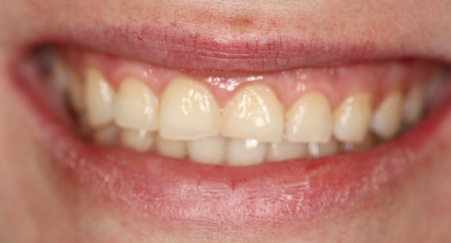 Tooth before cosmetic composite filling restoration in Katy, TX