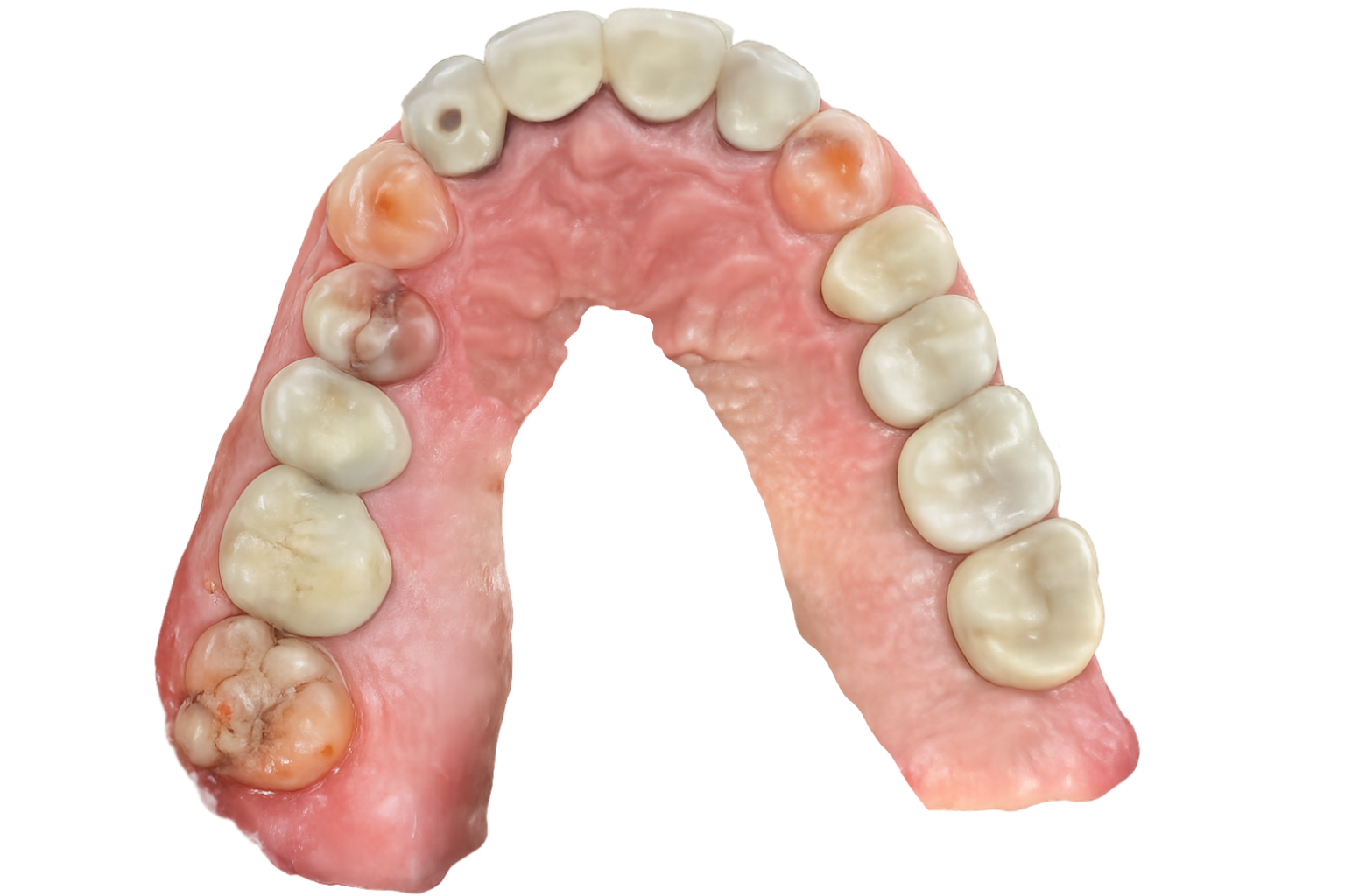 Restored smile after dental implant crown placement at Bethke Family and Cosmetic Dentistry