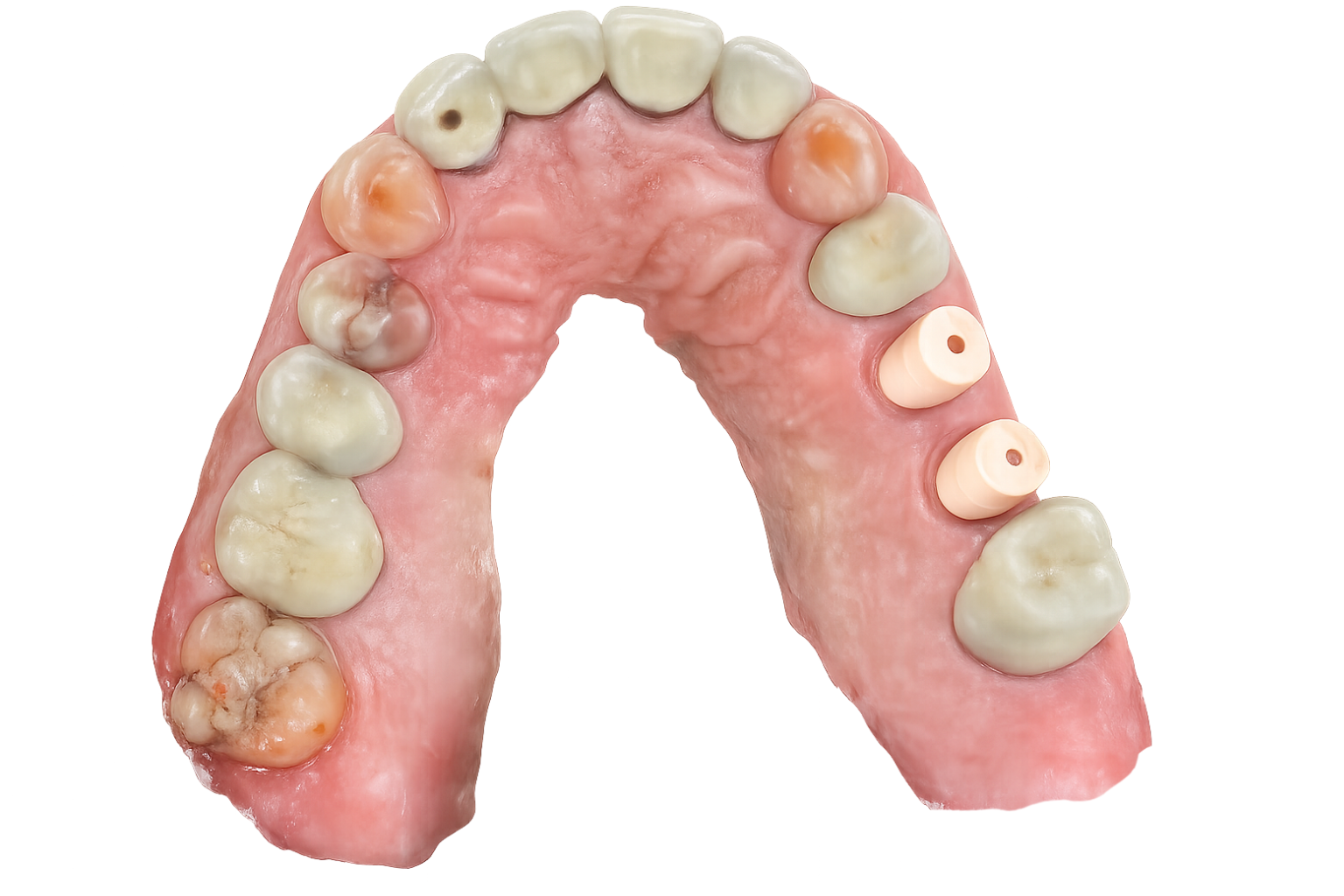 Missing tooth before dental implant placement in Katy, TX