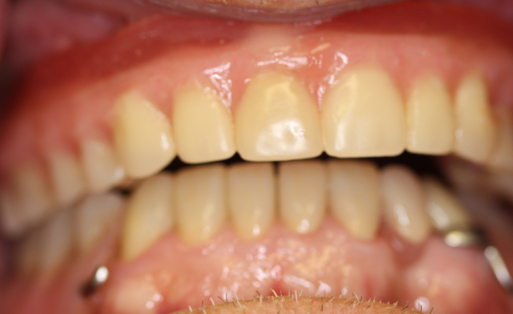 Patient smile after partial denture treatment