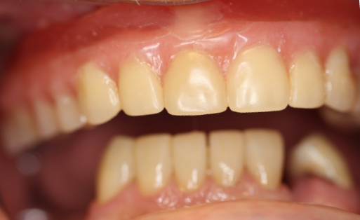 Patient smile before partial denture treatment in Katy, TX