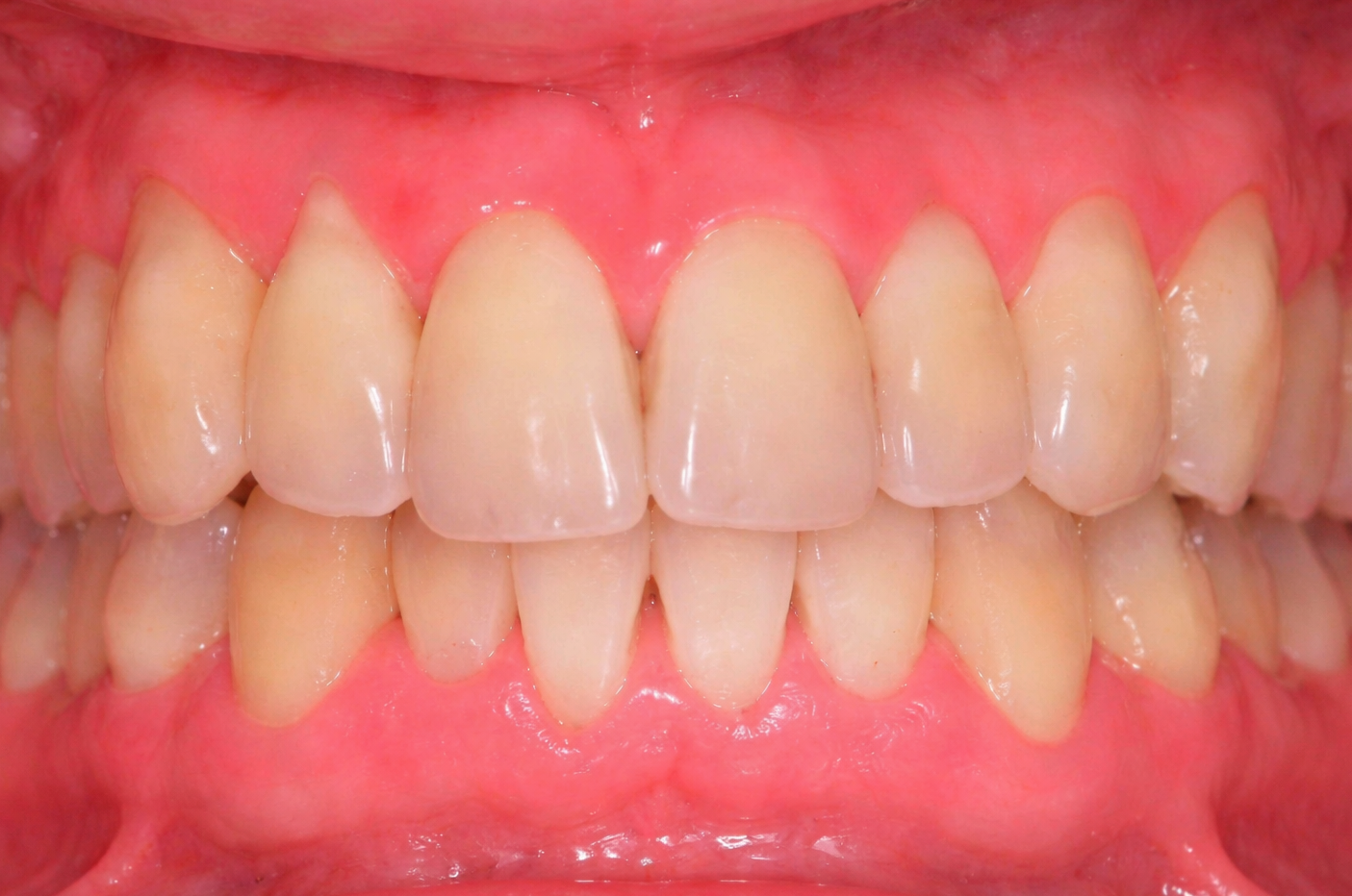 Healthy gums after periodontal scaling and root planing therapy