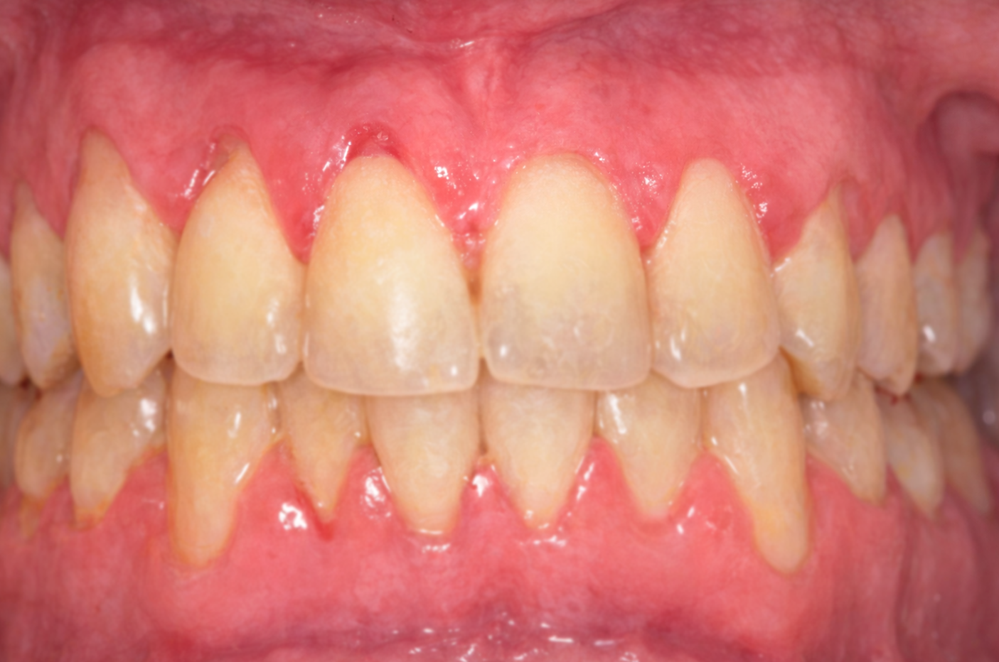Gums with periodontal disease before deep cleaning treatment in Katy, TX