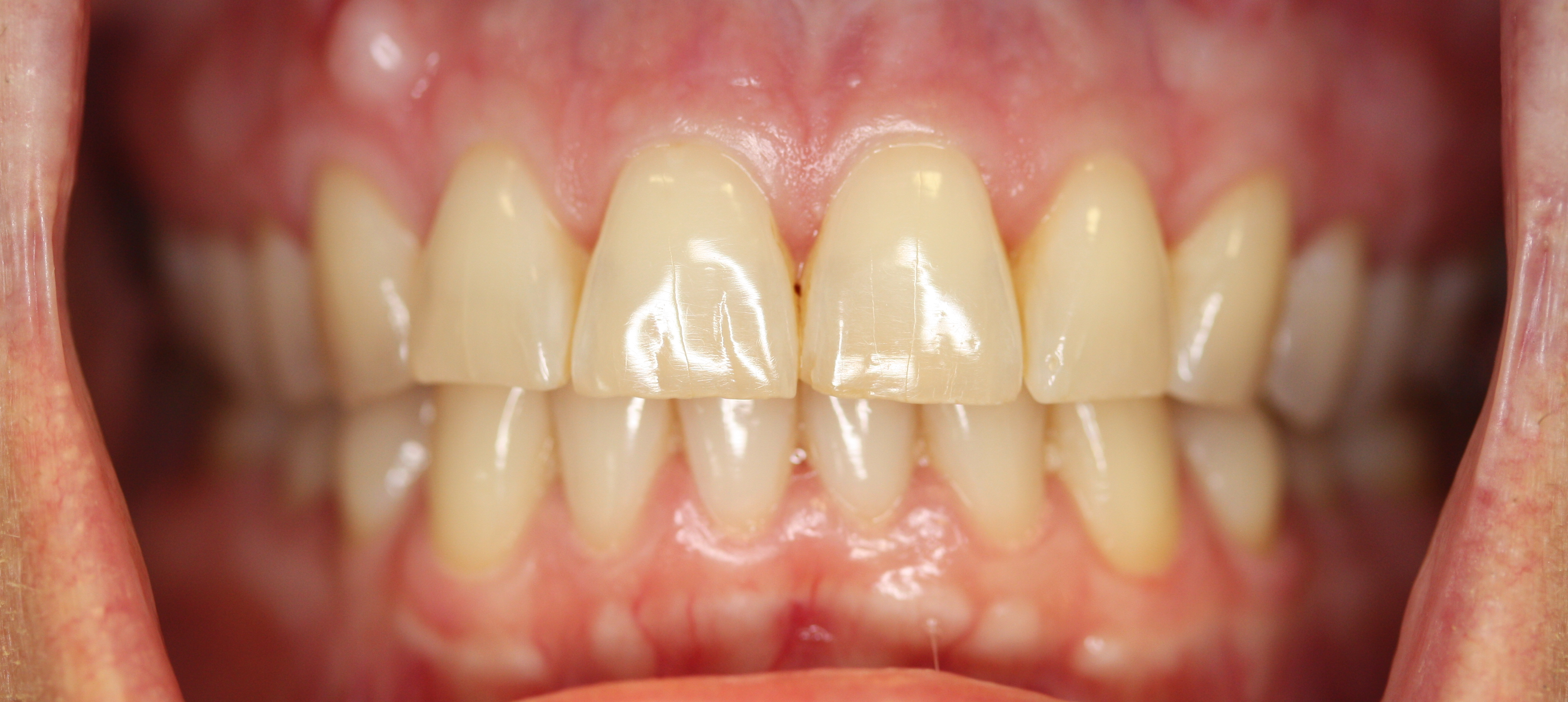 Teeth after professional whitening - dramatically brighter smile
