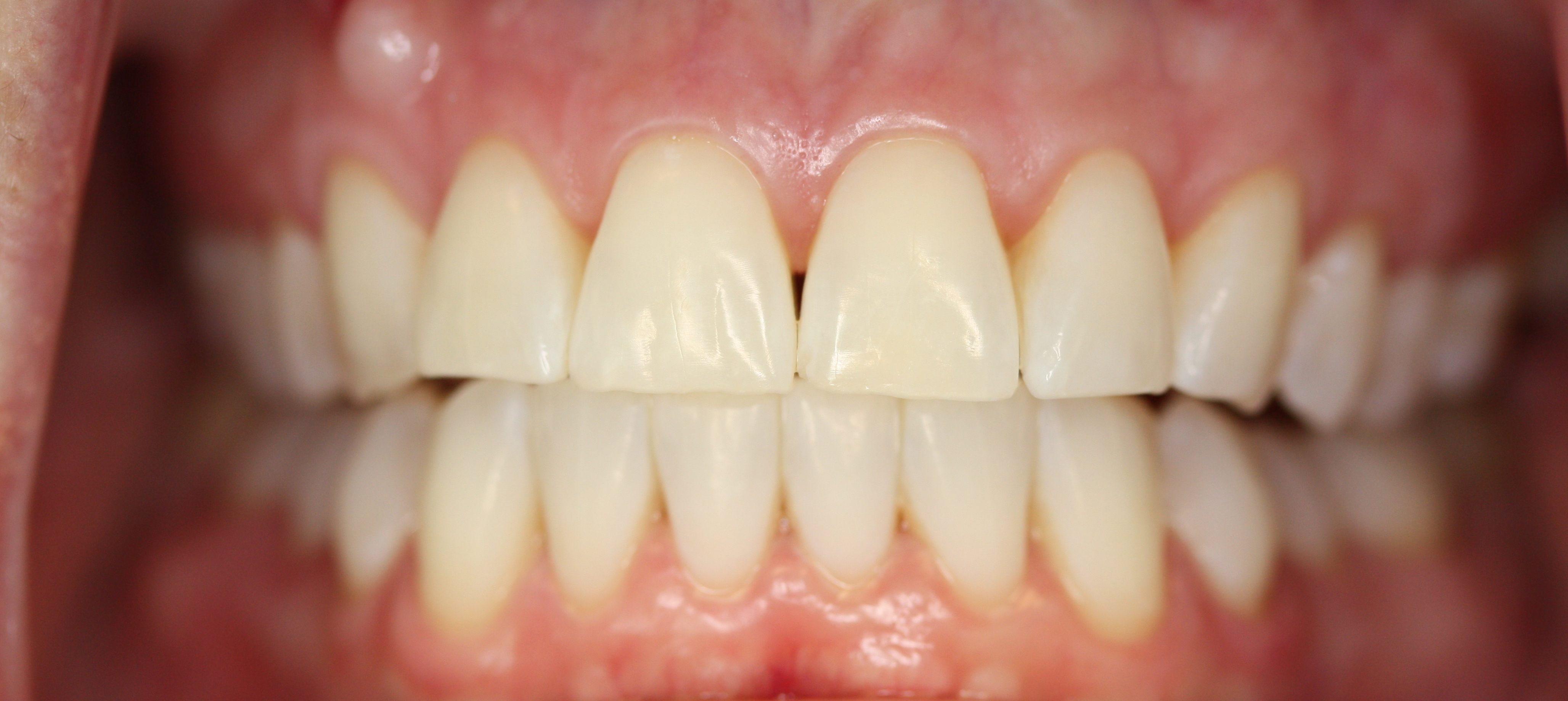 Stained teeth before professional whitening treatment in Katy, TX